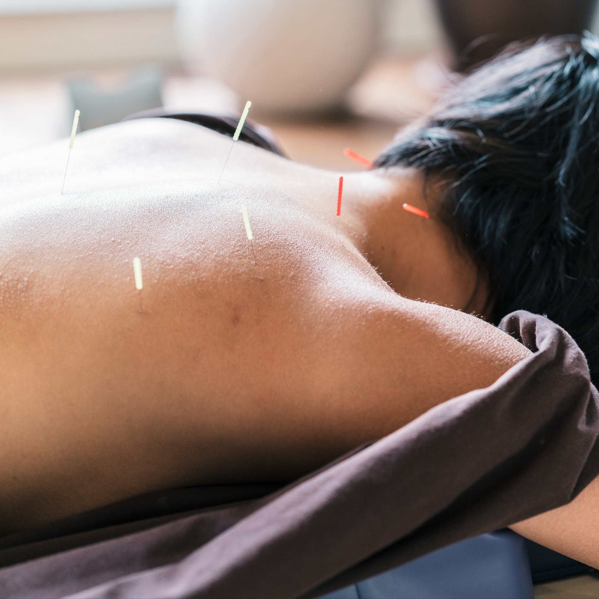 therapist-giving-cupping-treatment-to-young-asian-2024-09-13-16-53-24-utc