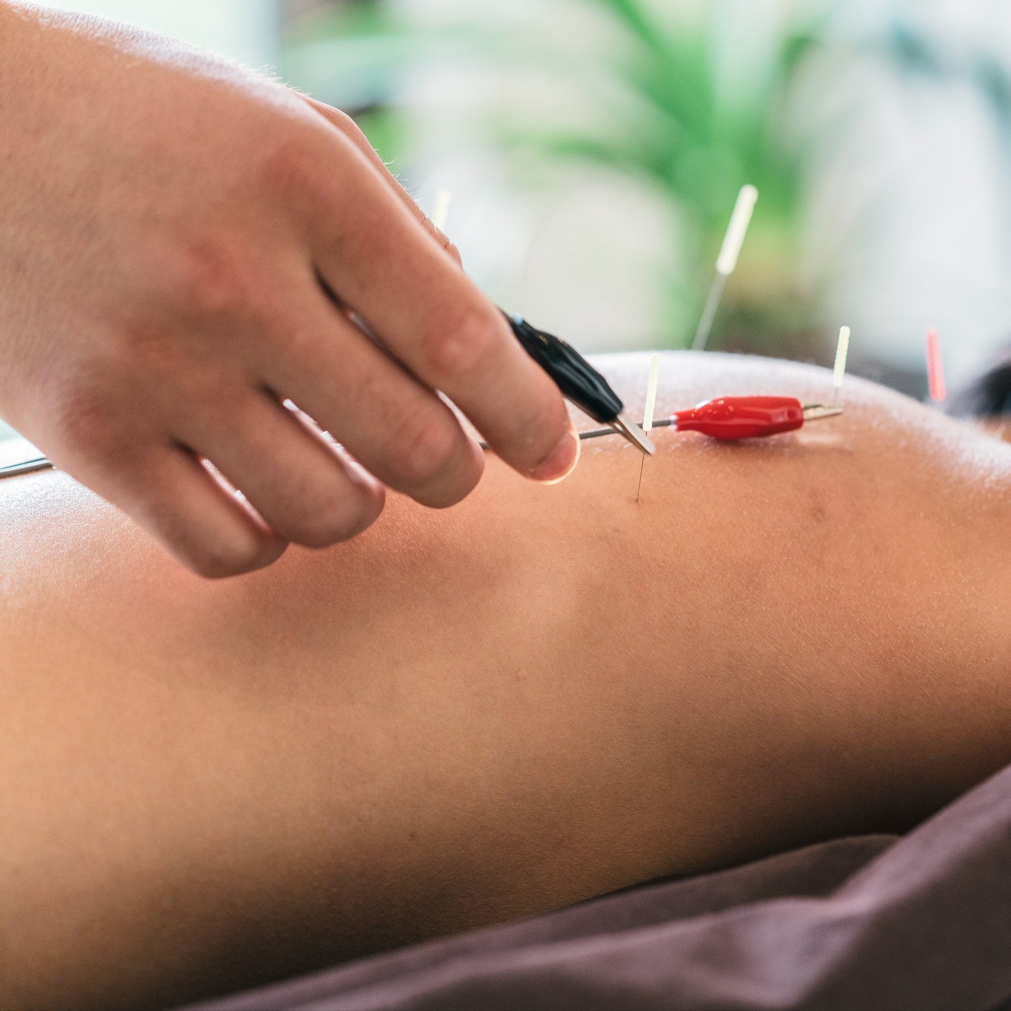 therapist-giving-cupping-treatment-to-young-asian-2024-09-22-06-29-46-utc